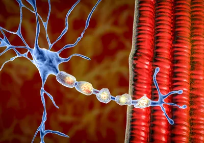 3D illustration of damaged myelin sheath seen in demyelinating diseases such as multiple sclerosis.